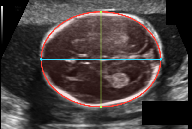 Fetal head ultrasound with biometry overlay
