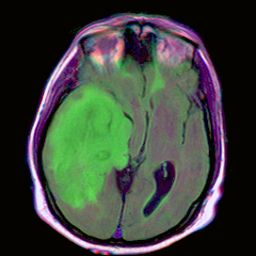 Sample brain MRI with tumor overlay